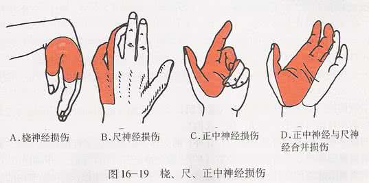 神经损伤恢复时间 手神经损伤怎么办