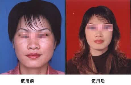 黄褐斑喝中药多久能好 中药去黄褐斑秘方 效果好吗