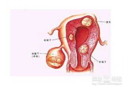 子宫肌瘤和子宫腺肌症 子宫肌瘤是什么症状 子宫腺肌瘤的症状是什么