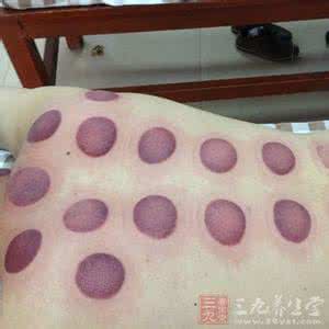 拔火罐的方法 拔火罐的方法 巧拔火罐更健康