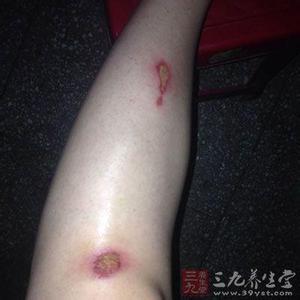 艾滋病初期症状皮疹 皮疹症状 这些表现就是皮疹的症状