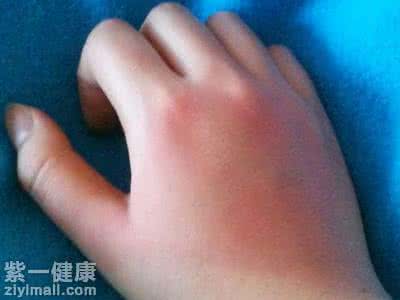 手被开水烫了怎么处理 【手被开水烫了怎么办】手被开水烫了怎么处理