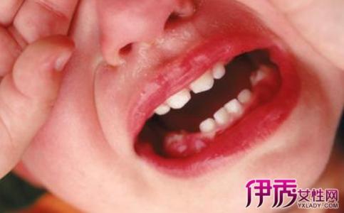 牙龈肿痛发炎怎么办 牙龈发炎怎么办 牙龈肿痛怎么办？