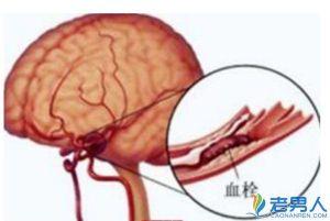 脑血栓的治疗方法 得了脑血栓怎么办 脑血栓的治疗方法