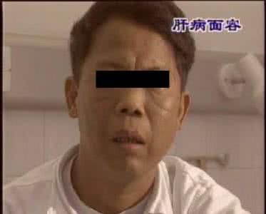 肝病面容症状 肝病面容 肝病面容是如何造成的