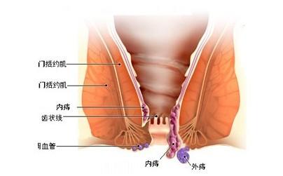 肛门里面疼痛是直肠癌 肛门疼痛