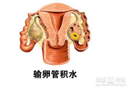 输卵管积水吃什么中药 输卵管积水中药治疗 输卵管积水吃什么药？