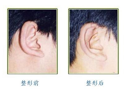 杯状耳整形价格 耳部整形 贝壳状耳的耳部整形矫正法