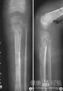 急性化脓性骨髓炎治疗 急性化脓性骨髓炎 急性化脓性骨髓炎怎么治