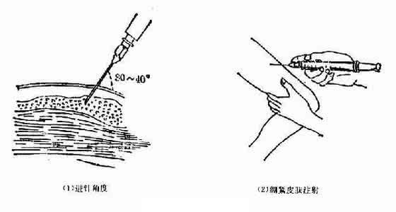 皮下注射 皮下注射操作流程 皮下注射