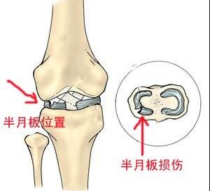 膝盖半月板损伤怎么治 膝盖半月板损伤是怎么个情况