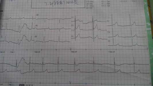 窦性心动过缓心律不齐 窦性心动过缓伴不齐 心律不齐的五种情况