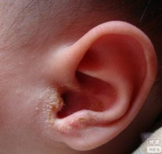 婴儿为什么老抓耳朵 耳朵出血 婴儿耳朵为什么会出血？