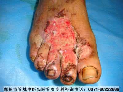 血栓栓塞性脉管炎 【台湾秘方】治疗下肢栓塞性脉管炎，治疗20例，效果良好