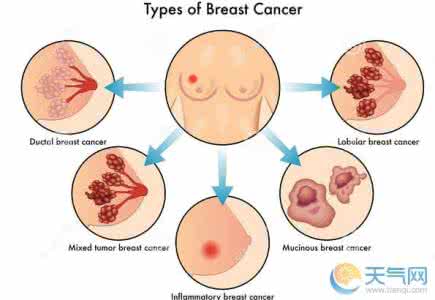 乳腺癌症状预防 乳腺癌初期症状 如何预防乳腺癌