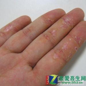 肛门湿疹的防治方法 湿疹怎么办 教你湿疹的正确防治方法