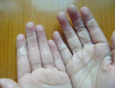 孩子睡觉手脚经常抖动 手脚脱皮的原因 孩子手脚脱皮不同的原因