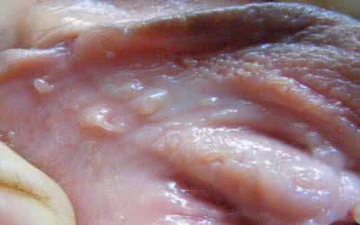 尖锐湿疣如何治疗 治疗它的方法有哪些