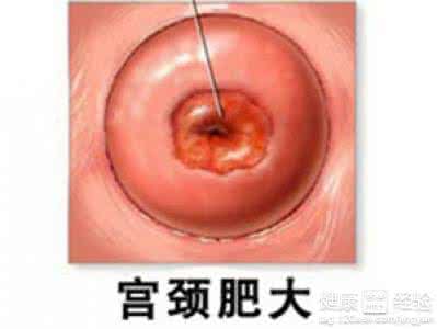 子宫充血是怎么治疗 子宫充血怎么治疗?