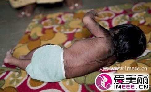 不可思议迷宫狼人药剂 狼人综合症 罕见！8种不可思议的怪病_狼人综合症