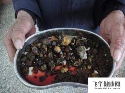 慢性胆囊炎 胆结石 慢性胆囊炎 朱培庭