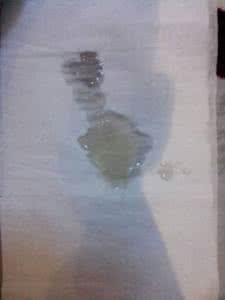 眼底出血是怎么回事 撸管精液带血是怎么回事 如何治疗