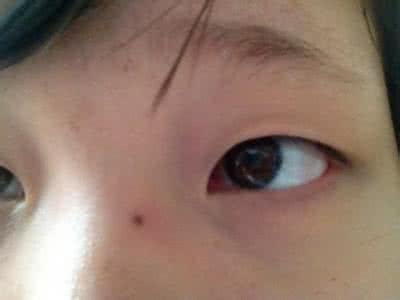 疤痕体质割双眼皮 什么是疤痕体质 这类人割双眼皮竟是在毁容