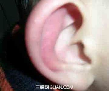 耳朵长冻疮了怎么办 天冷警惕耳“冻疮”