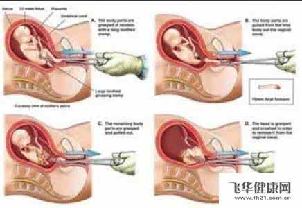 人工流产钳刮术视频 人工流产手术之钳刮术的介绍