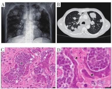 寄生虫病例 NEJM发布惊人病例 寄生虫在人体恶变为肿瘤