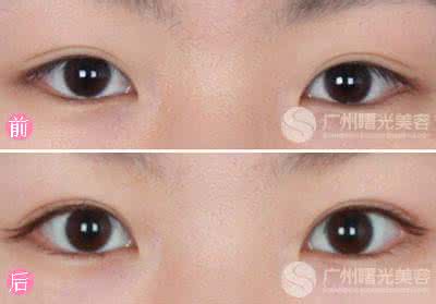 埋线重睑术需要多少钱 埋线重睑术需要多少钱 埋线重睑术适应者及优点