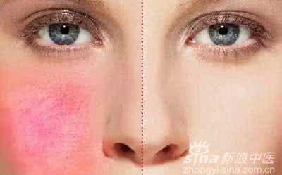 为什么会长红血丝 脸上为什么会长红血丝 为什么冬天脸长红血丝