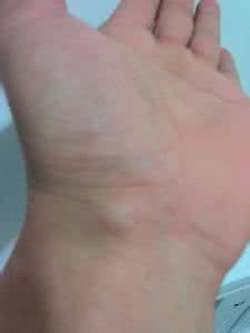 治疗手腕腱鞘炎偏方 手腕上的筋包怎么治疗？