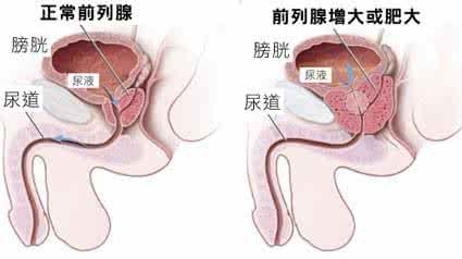 治疗前列腺肥大的症状 前列腺肥大症如何治疗？
