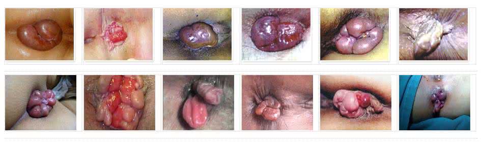 女性治痔疮的根治办法 有痔疮怎么办 痔疮的治疗办法