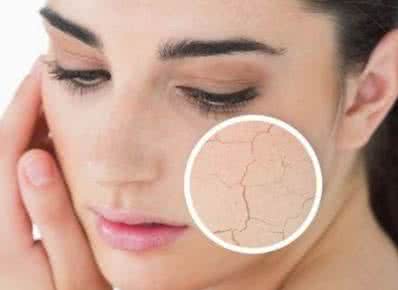 皮肤干燥是什么原因 皮肤干燥是什么原因 皮肤会干燥的原因有哪些