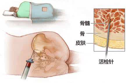 骨髓穿刺有副作用吗 骨髓穿刺有影响吗？