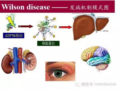 变性手术男变女效果图 效方治疗肝豆核变性