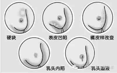 乳腺癌是生气引起的吗 乳腺癌是生气引起的吗 乳腺癌是怎样形成的？