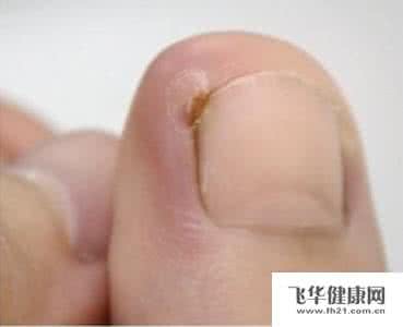 根治甲沟炎的偏方 治疗甲沟炎偏方