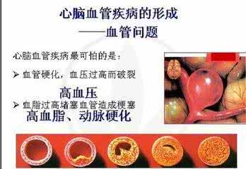 心脑血管疾病自测 看自己是不是得心脑血管疾病了,试试自测吧