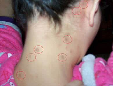 脖子长痘痘的原因 脖子长痘痘的原因 脖子长痘痘是什么原因？怎么治？