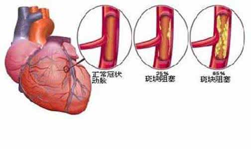 冠心病是什么引起的 冠心病是什么引起 冠心病是由什么引起