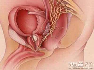 前列腺结石吃什么排石 前列腺结石的症状