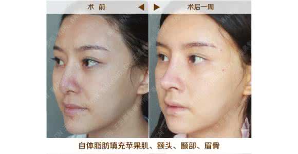 自体脂肪填充额头价位 做额头脂肪填充术 额部填充术完全介绍
