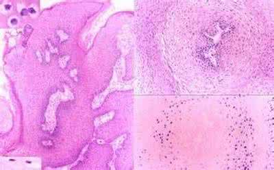 肛周脓肿复发怎么办 尖锐湿疣复发怎么办 肛内尖锐湿疣复发怎么办