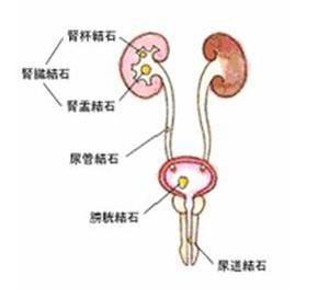 肾结石和尿道结石 胆、肾、尿道结石(比碎石机还灵的结石秘方,大小结石都能化)
