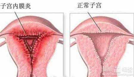 子宫内膜炎的症状 子宫内膜炎的症状 正确了解子宫内膜炎病