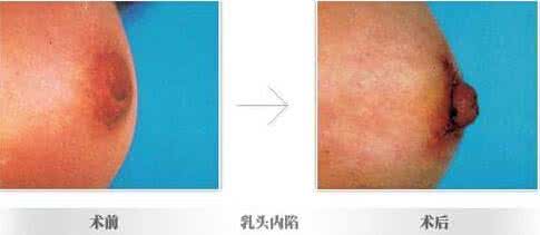 乳头内陷矫正术价目表 乳头内陷可以娇正的方法有几种？