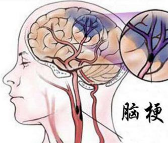脑梗塞能治好吗 什么是脑梗塞